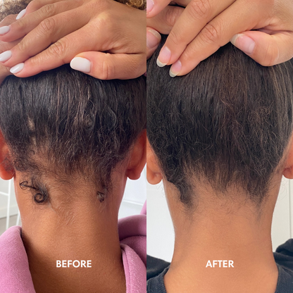 Rosemary Oil For Hair Growth Before and After