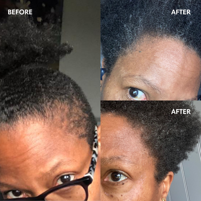 Hair Growth Before And After Rosemary Oil